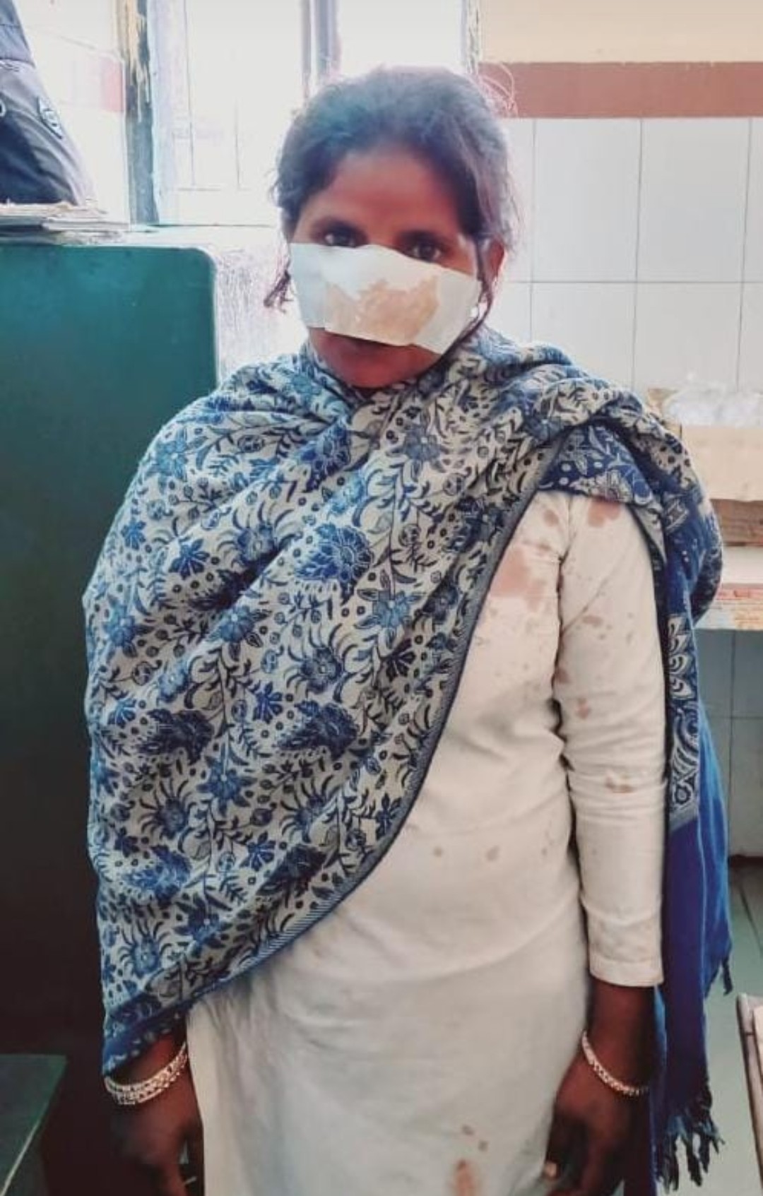 पति ने पत्नी की नाक को दांत से काटकर किया घायल